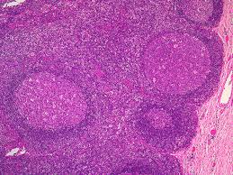 Pathology Outlines Follicular Hyperplasia