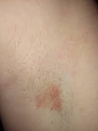 Krasnoe Pyatno Pod Myshkoj Kotoroe Ne Cheshetsya Vopros Dermatologu 03 Onlajn