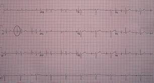Super angebote für pacemaker f80 hier im preisvergleich. Artificial Cardiac Pacemaker Wikiwand