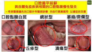 嘴巴裡長出白色的條紋，小心會變成口腔癌的這2種原因！ - Heho健康