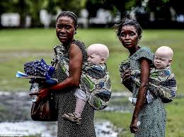 Girl Seeks Refuge From Witch Doctors Who Want Her Because She S Albino Albinism Albino Tanzania