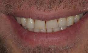 Zahn Veneers Bonn Veneers Fur Blendend Schone Zahne