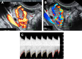 Image result for corpus luteum sonography)