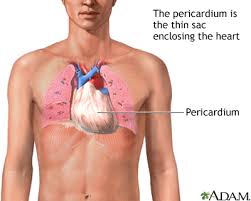 Symptoms of myocarditis include chest pain, shortness of breath, fatigue, and fluid accumulation in the lungs. Pericarditis After Heart Attack Medlineplus Medical Encyclopedia