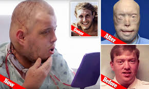 Mississippi firefighter Patrick Hardison has most extensive face transplant  ever