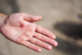 Image result for Hand Injury