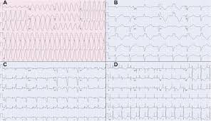Image result for Flecainide Overdose