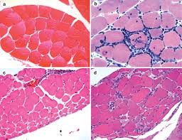 When admitted to hospital one question i was asked was do you take a statin. Autoimmune Myopathies Autoantibodies Phenotypes And Pathogenesis Nature Reviews Neurology