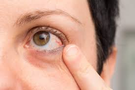 Todo Sobre Los Ojos Rojos Vision