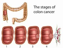 Such symptoms, as osterberg experienced, are easily overlooked as being the result of eating something unusual or a bit of indigestion. Bowel Cancer Screening London Gastroenterology Centre
