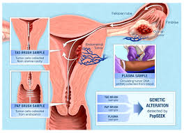 Image result for Cervical Cancer