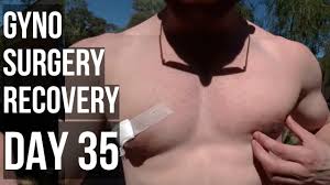 Gyno Surgery Recovery Day 35 Slowly Getting Back To Normal Youtube