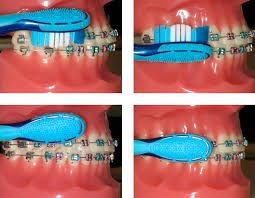 Use any kind of toothpaste, and brush flat against the braces, and down over the brackets, so you're pushing any food or debris out from under the wire. Brushing With Braces Orthodontic Treatment In Wollongong Smile Team Orthodontics