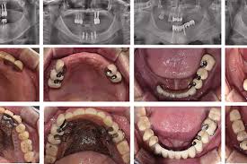 Image result for dentures