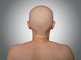 Hair loss is one of the common problems in men. Overview Of Hair Loss My Hair Doctor Prescription Haircare