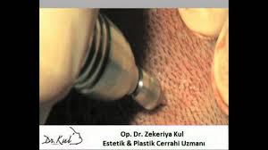 Sac Ekimi Operasyon By Op Dr Zekeriya Kul