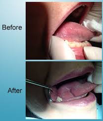 Signs and symptoms may include: Don T Smoke You Could Still Get Oral Cancer