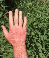 Jun 10, 2019 · nettle rash symptoms and treatment tips we look at the causes, symptoms and treatments for hives, a skin rash that presents itself as reddish itchy weals or swellings in the skin. Https Phc Amedd Army Mil Phc 20resource 20library Stingingnettle Fs 18 086 0716 Pdf