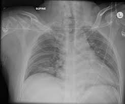 Image result for Flail Chest