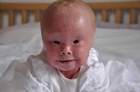 Harlequin ichthyosis is an extremely rare genetic skin condition. Harlequin Ichthyosis Causes Symptoms Diagnosis Survival Treatment