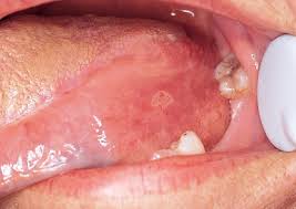 They can be a reason for great concern for those who experience it. What Causes Mouth Sores Oral Health Aspen Dental