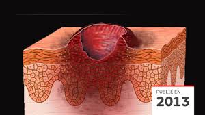 Ulcer