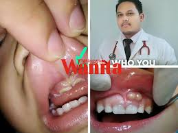 Penjagaan gigi seharusnya sejak awal lagi iaitu dari kecil, bagaimanapun, pengambilan suplimen juga sangat penting untuk mendapatkan gigi yang sihat dan. Gigi Rongak Jadi Punca Muncul Benjolan Kecil Bernanah Di Gusi Mingguan Wanita