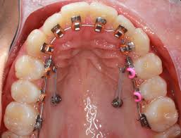 Lingual braces are braces that are positioned on the rear side of the teeth, next to the tongue. In Ovation L Mtm Orthodontist San Diego Clear Braces