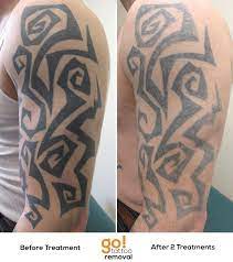 To help you get a better idea of. Go Tattoo Removal Lehigh Valley Laser Tattoo Removal