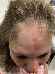 Basic and specific (basp) classification for pattern hair loss (from: Frontal Fibrosing Alopecia Preceding The Development Of Vitiligo A Case Report Jaad Case Reports