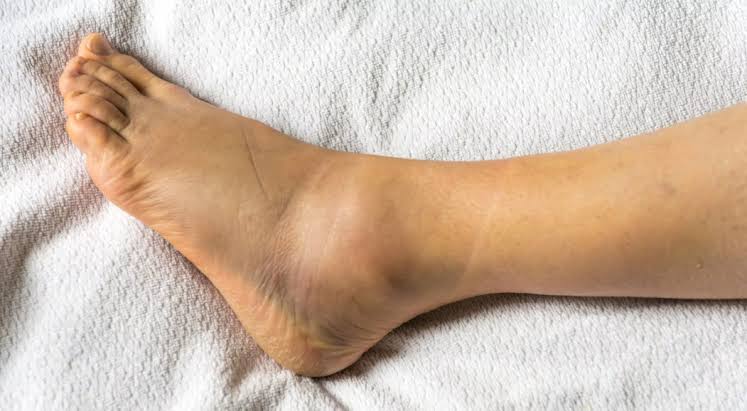 Ankle sprain after sports