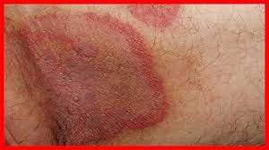 Tratamiento Para La Tina Inguinal O Hongos En La Entrepierna De Hombres Youtube