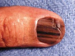Image result for Acral lentiginous melanoma nail