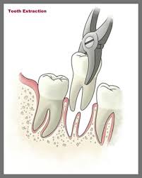 Image result for Tooth Extraction