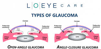 Glaucoma is the primary cause of irreversible blindness worldwide. Did You Know There Are Different Types Of Glaucoma Lo Eye Care