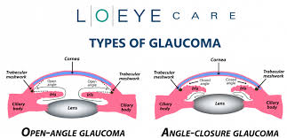Glaucoma is a complex disease in which damage to the optic nerve leads to progressive, irreversible vision loss. Did You Know There Are Different Types Of Glaucoma Lo Eye Care