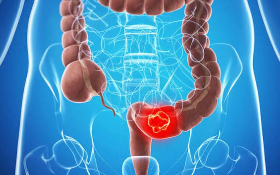 8 dấu hiệu cảnh báo sớm ung thư đại trực tràng