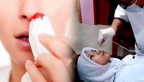 Kanser pangkal hidung , nasopharyngeal cancer tidak mengenal siapa. Hidung Kerap Tersumbat Mungkin Tanda Kanser Pangkal Hidung