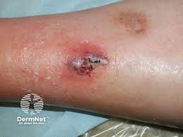 Image result for Pyoderma Gangrenosum
