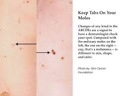 The first step in diagnosing skin cancer is a i had biopsies of a flat beige spot on my cheek and a scaly shin colored spot on my nose. Would You Know Skin Cancer If You Saw It