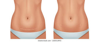 Cesarea Imagenes Fotos De Stock Y Vectores Shutterstock