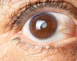 Kataraktlı ve sağlıklı bir gözün karşılaştırması resmi