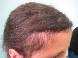 In general, the cause of alopecia in children is the effect on the hair follicles of various adverse factors leading to progressive hair loss. Hair Loss In Children Etiologies And Treatment Intechopen