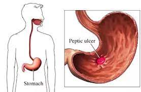 I Always Feel I Have Acidity Or Feel My Stomach Is Full Even If I Don T Eat Especially On The Morning My Stomach Frequently Feels Unwell Is This Normal Quora