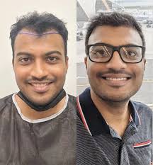 Hair Transplants in Tampa, FL
