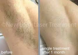 I've used pfb vanish, exfoliating, along a heating pad. New Look Laser Treatment Armpits Are A Popular Laser Hair Removal Choice And We Get Brilliant Results It Speeds Up Your Routine And Stops Ingrown Hairs Armpit Hair Is Often Quite