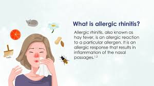 Image result for Rhinitis