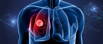 If you have reason to be concerned about lung cancer, research some of the common diagnostic tools. Lung Cancer Statistics World Cancer Research Fund International