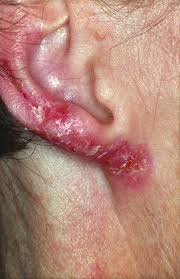 Skin biopsy from the deep keratotic areas will reveal marked epidermal hyperplasia and noncaseating epitheloid cell granulomas with lymphocytes and plasma cells in the. Mykobakterieninfektionen Der Haut Pdf Kostenfreier Download