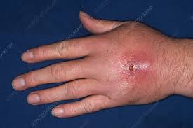 Image result for Hand Infection